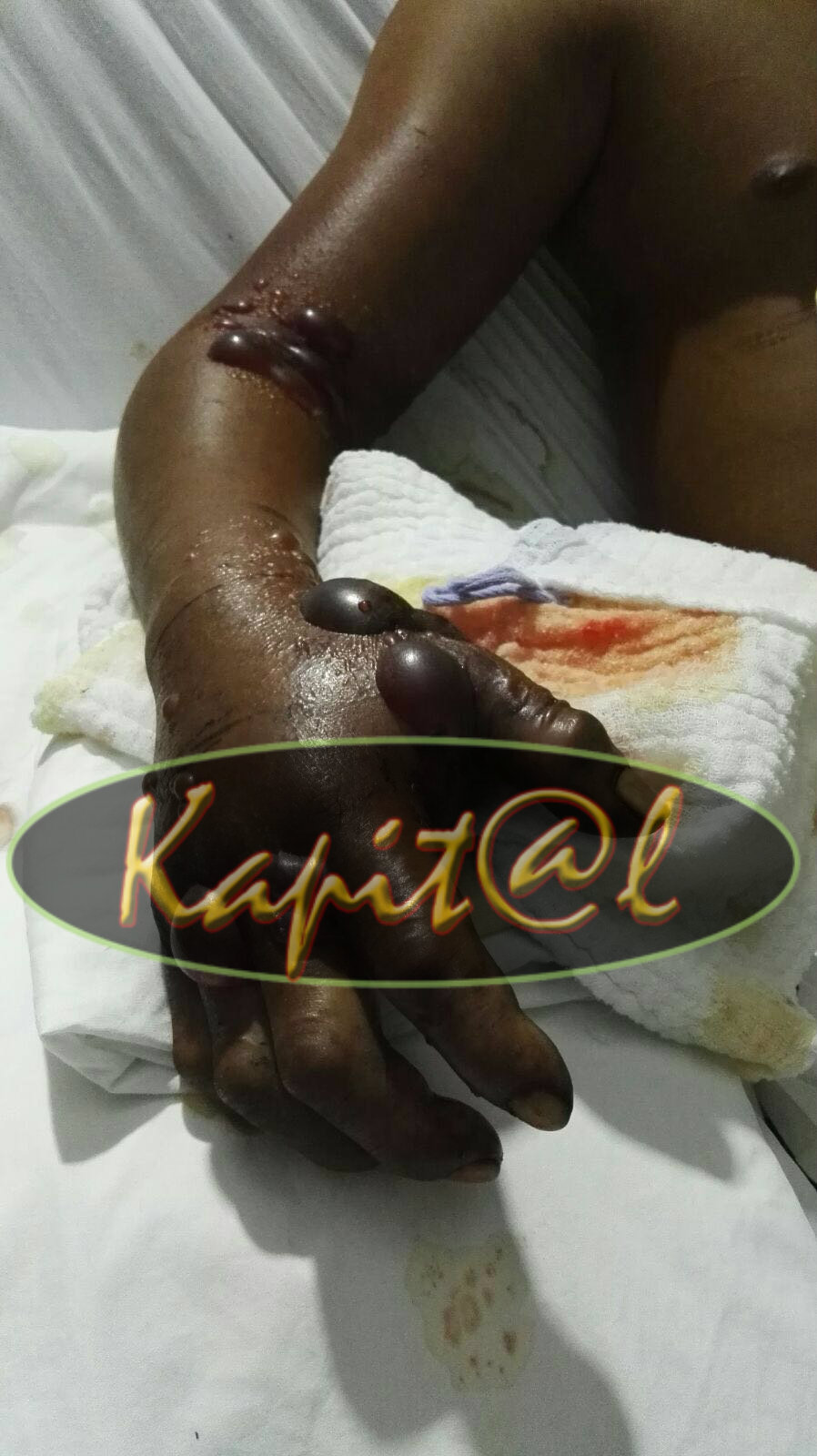  Entre la vida y la muerte se debate indígena que fue mordido por una serpiente. Recibe atención médica en el hospital.